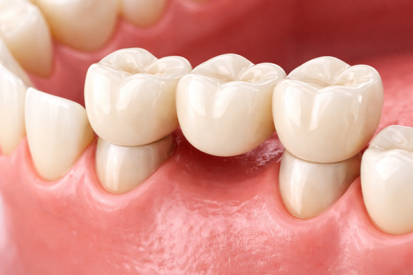 Dental crown restoration at Perth Prime Dental in Perth CBD