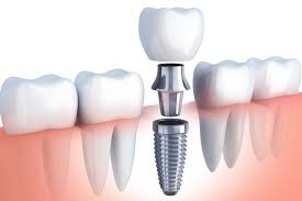 Keyword search volume for dental implants Perth and related cost phrases 