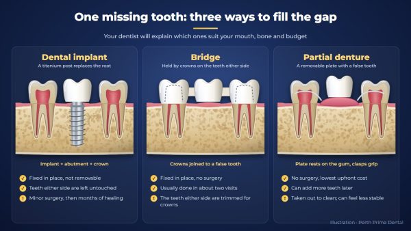 Illustration comparing three ways to replace one missing tooth: a dental implant with a crown between two natural teeth, a bridge held by crowns on the teeth either side, and a removable partial denture with clasps