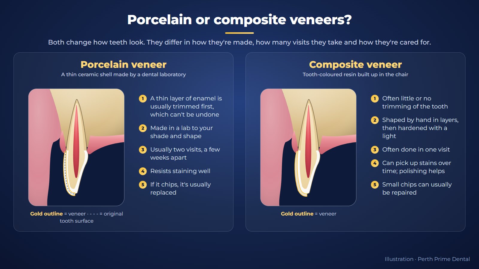 Side-by-side cross-sections comparing a porcelain veneer, a lab-made shell after a thin layer of enamel is trimmed, with a composite veneer built up on the tooth in layers, with the main differences listed