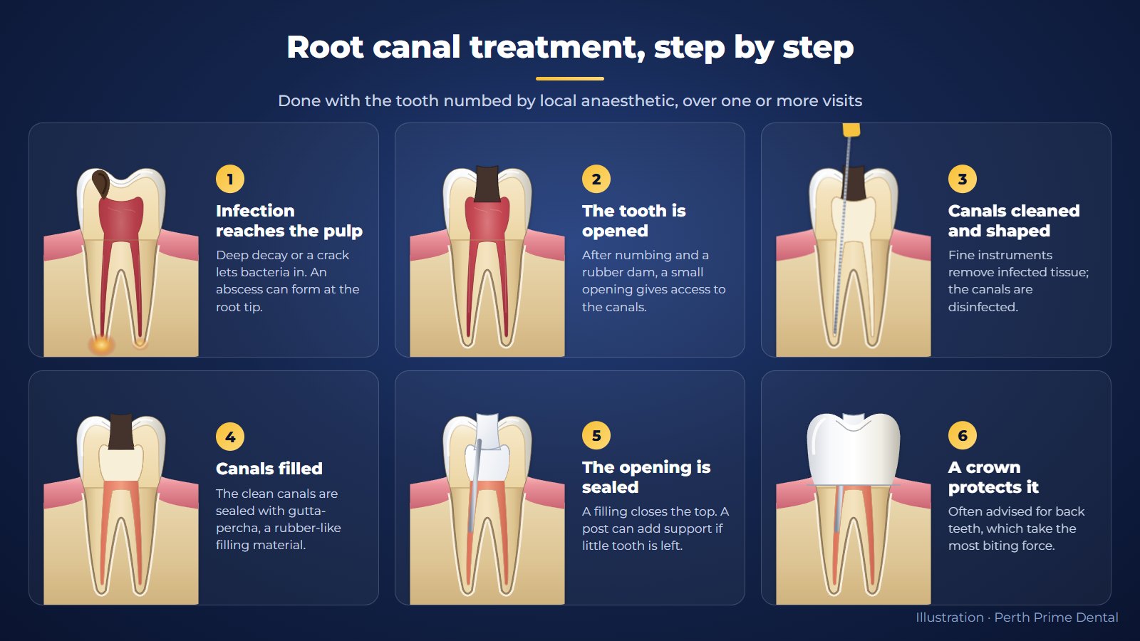 Root canal treatment in six steps: infected pulp with an abscess, tooth opened, canals cleaned with a fine file, canals filled with gutta-percha, opening sealed with a filling and post, crown fitted