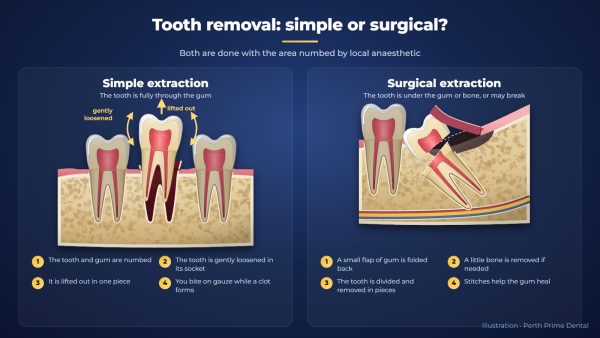 Illustration comparing a simple extraction, where a tooth is loosened and lifted out, with a surgical extraction, where a gum flap is opened and an impacted wisdom tooth is divided into pieces