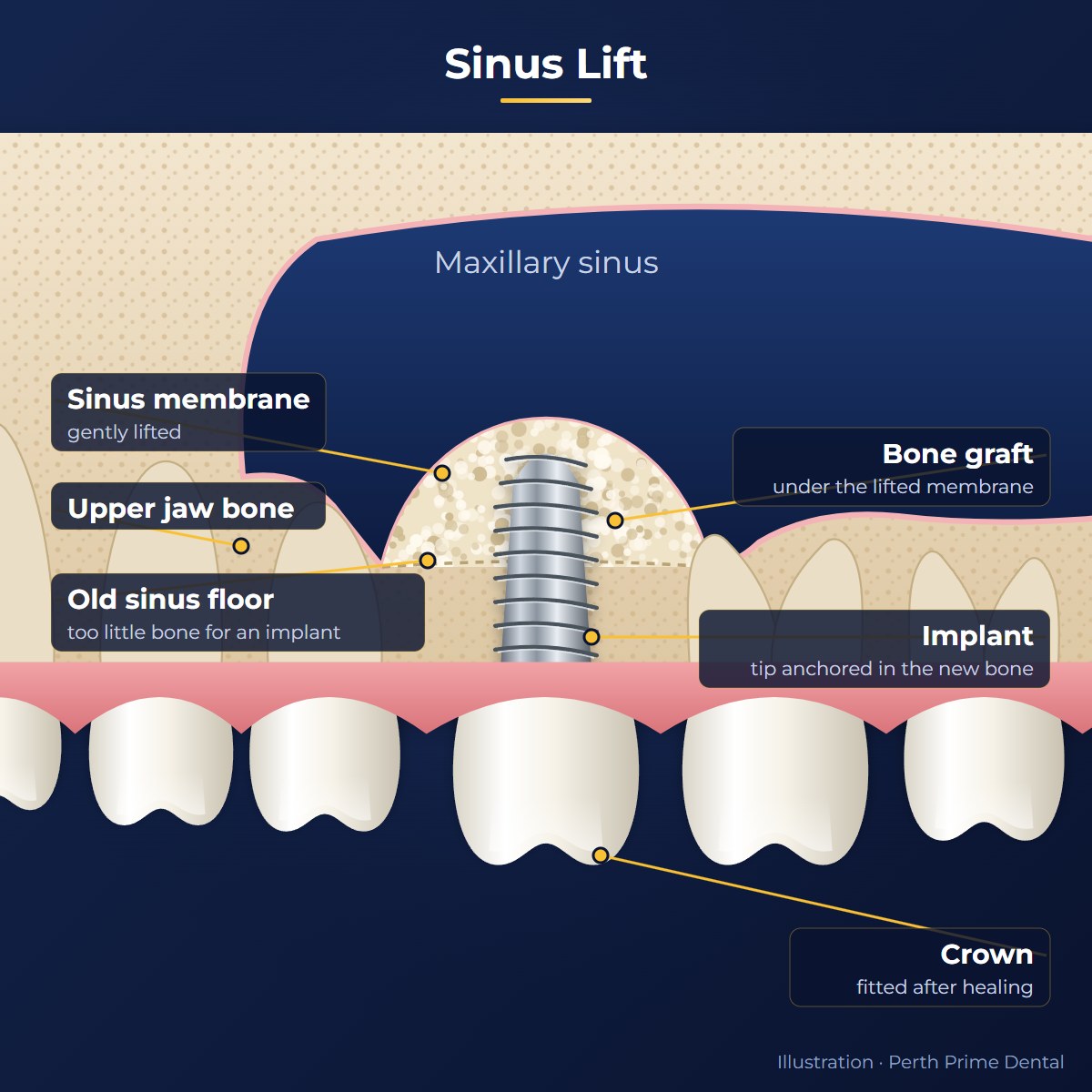 Sinus lift diagram: cross-section of the upper back jaw showing the maxillary sinus, the gently lifted sinus membrane, bone graft placed under it, and a dental implant with its tip anchored in the new bone and the crown in the mouth