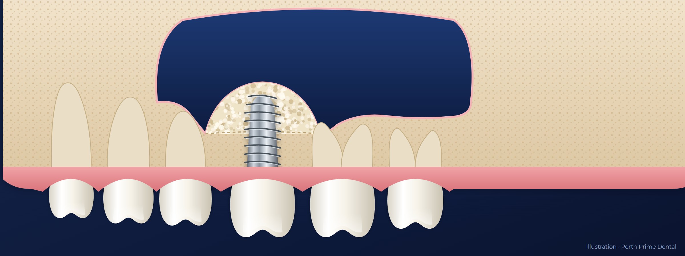 Illustration of the upper back jaw after a sinus lift: bone graft under the lifted sinus membrane, with a dental implant and crown among the natural teeth