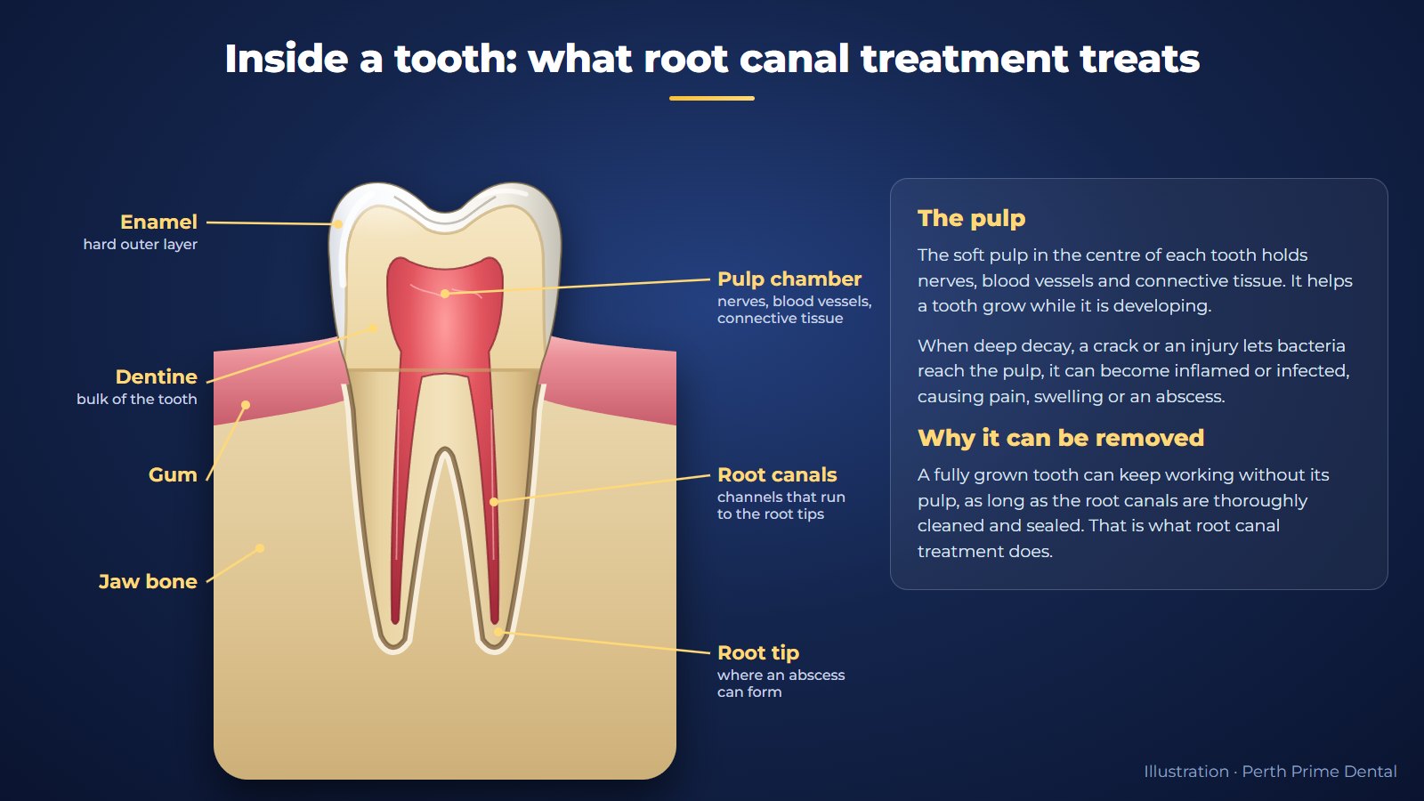 Cross-section of a molar tooth labelled with enamel, dentine, pulp chamber with nerves and blood vessels, root canals, root tip, gum and jaw bone