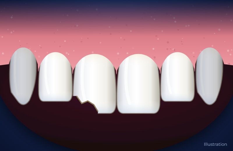 Illustration of upper front teeth with a chipped corner on one front tooth