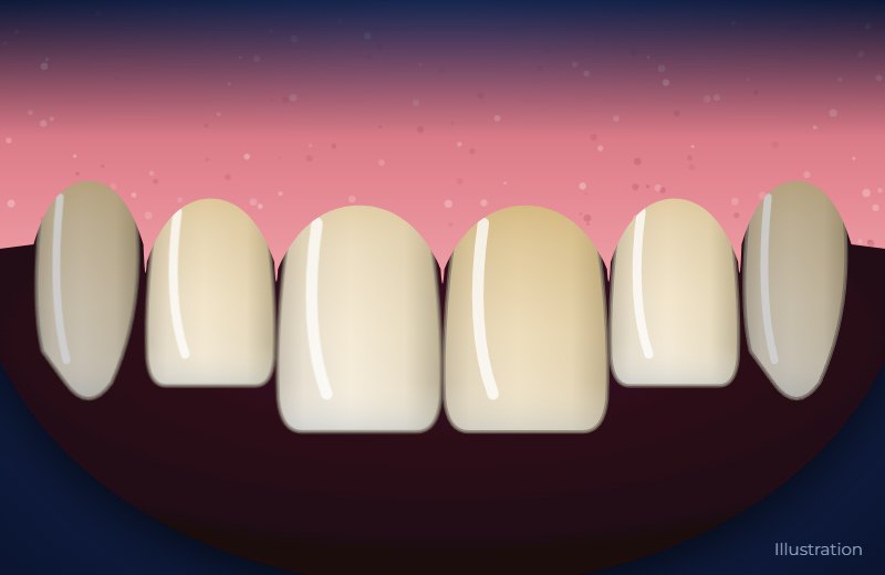 Illustration of upper front teeth with yellow and grey discolouration