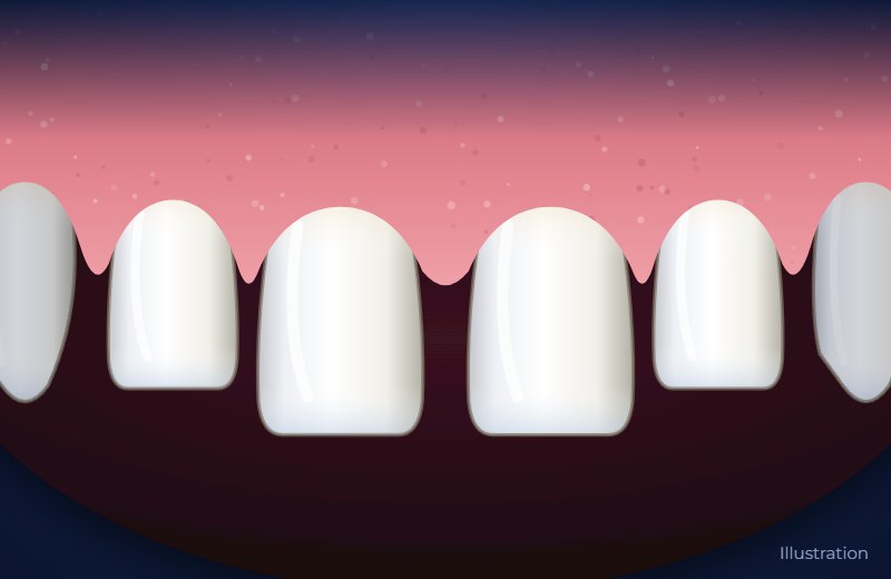 Illustration of upper front teeth with small gaps between them, including a gap between the two front teeth