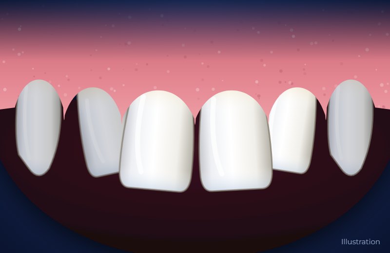 Illustration of upper front teeth that are slightly rotated and uneven