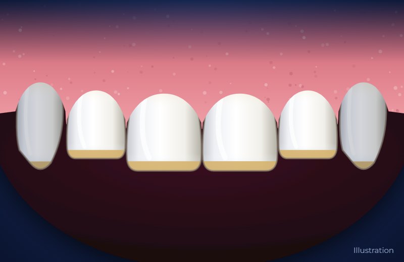 Illustration of short, worn-down upper front teeth with flattened edges