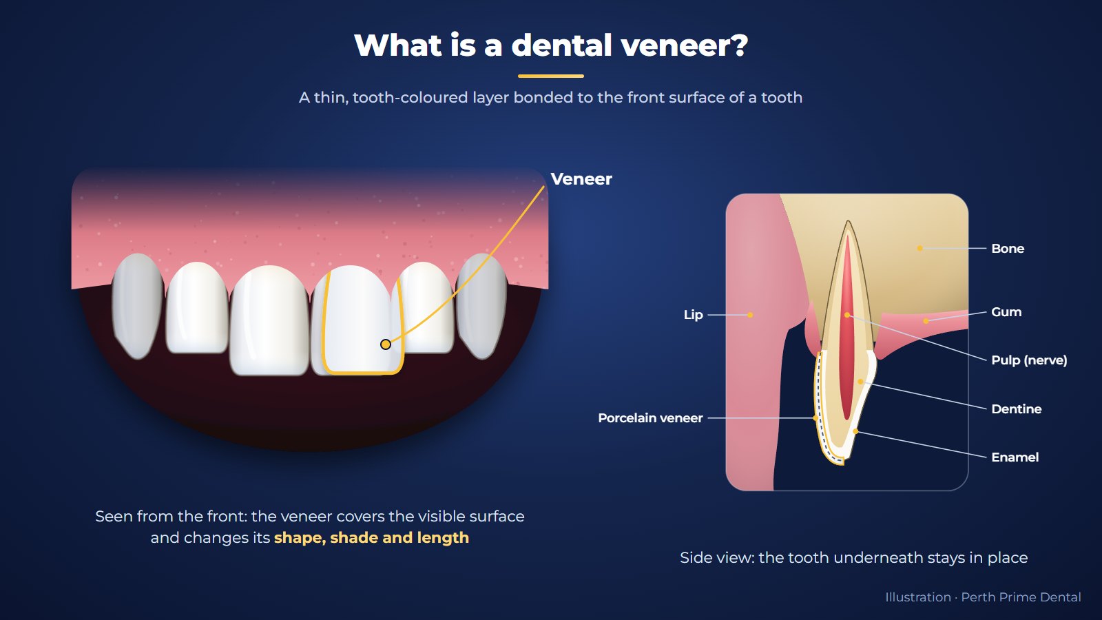 Illustration of upper front teeth with a veneer outlined in gold on one front tooth, and a side cross-section showing the thin veneer layer bonded to the front of the tooth over enamel and dentine